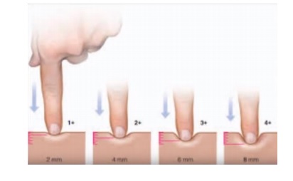 Fisioterapia Inovadora - Sinal de Cacifo ou Sinal de Godet, é pesquisado  pressionando um ou dois dedos na pele do paciente em uma região com edema.  O sinal é positivo quando, após